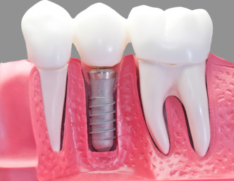 A dental implant works exceptionally well to anchor replacement teeth.