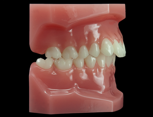 malocclusion-teeth-bad-bite