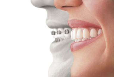 For complex orthodontic work, regular metal braces are often still the best choice to do the heavy lifting.