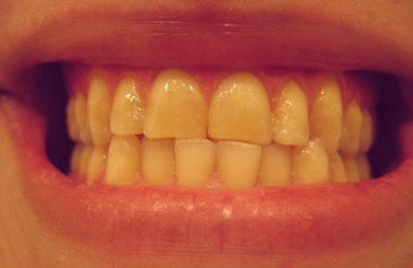 bruxism-teeth-grinding-clenching-resize