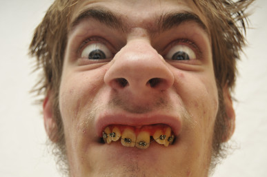 Hideous Monstrous Man staring at the camera with wide eyes, yellow crooked teeth with braces and huge nose. Eww! Ugly.