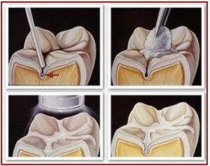 Dental Sealants