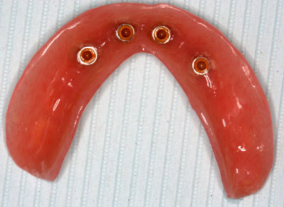 an implant overdenture