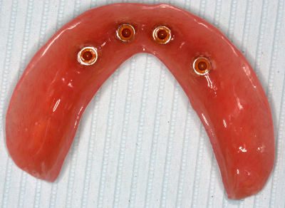 an implant overdenture