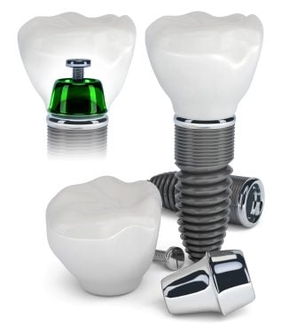 dental implant components and see-through version