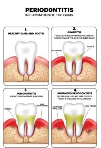 What is Periodontitis?