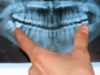 Panoramic Dental X-ray