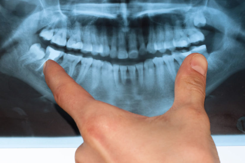 Why is my wisdom tooth broken?