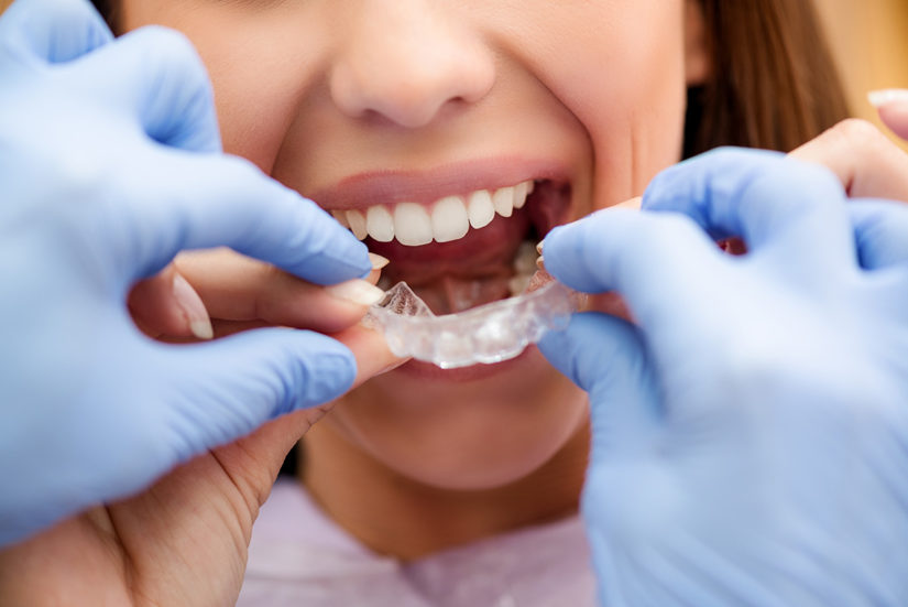 Can I Have an Allergic Reaction to Invisalign®?