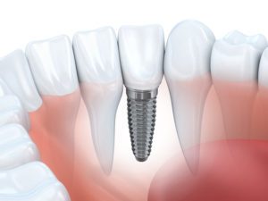 Dental Implants function as real teeth