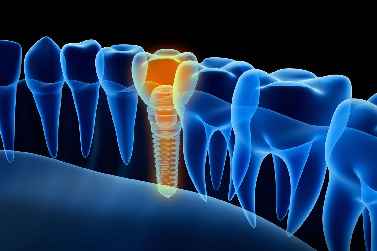 Dental Implants