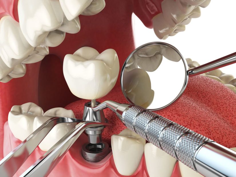 Defining Dental Implant Key Terms - from 123Dentist