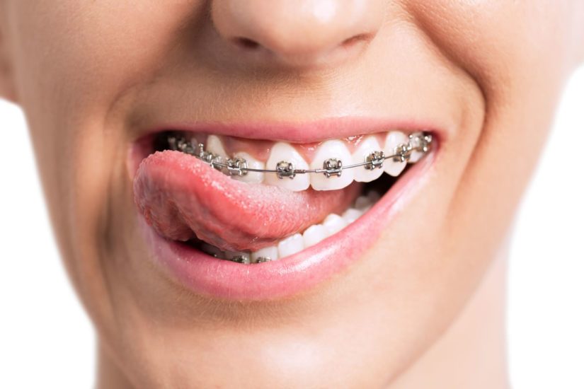 Invisalign Orthodontist In Frisco