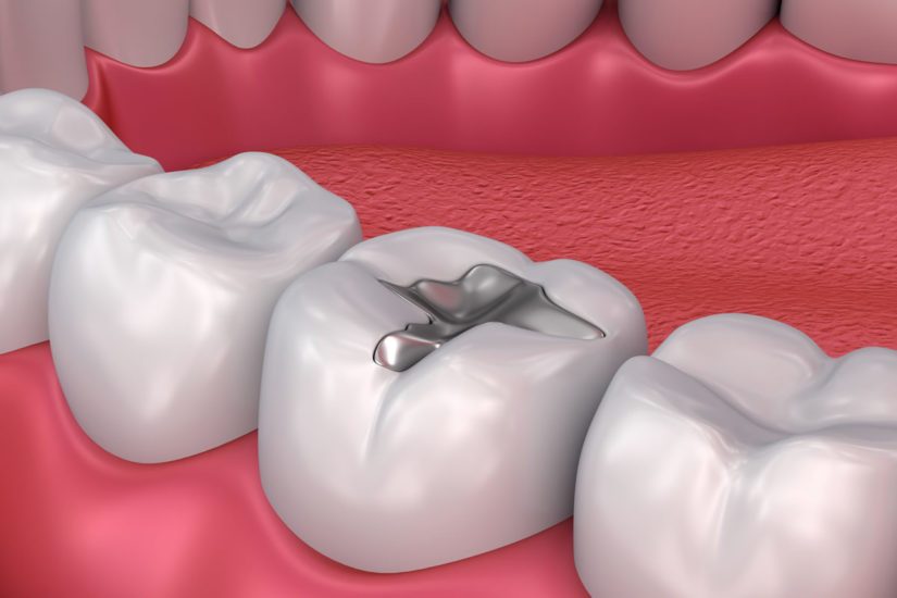 how long does a glass ionomer filling last