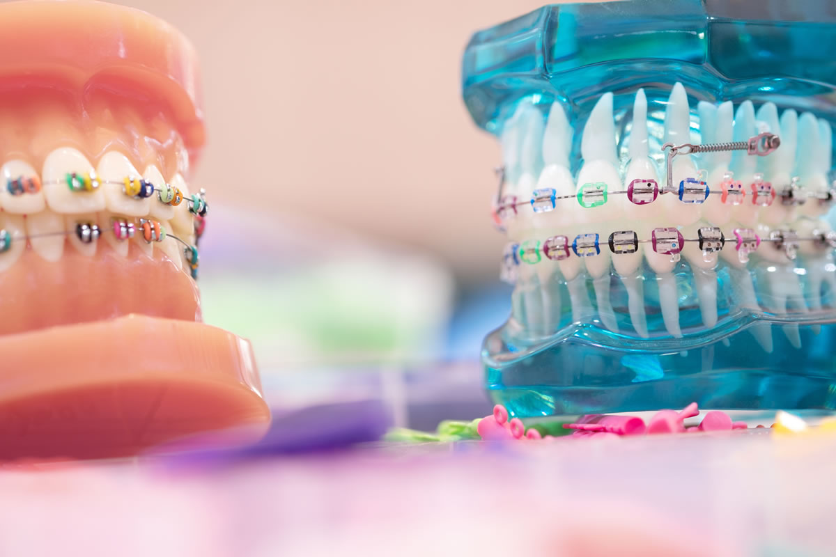 Does your child need orthodontic braces?