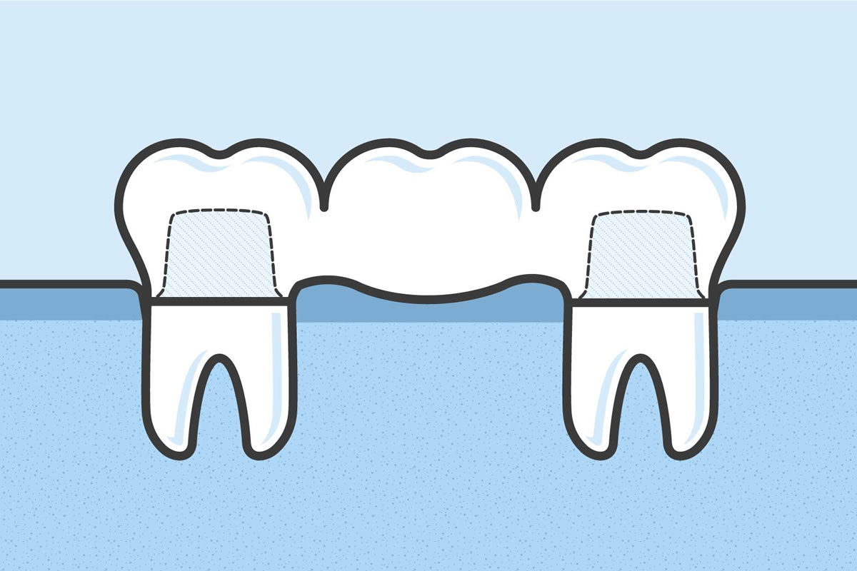 What are Dental Bridges and How Do They Work?