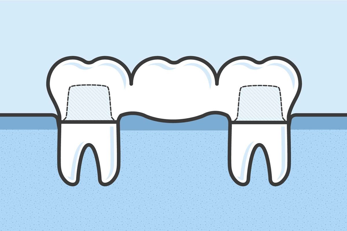 What are the benefits and types of undergoing temporary tooth bridges?