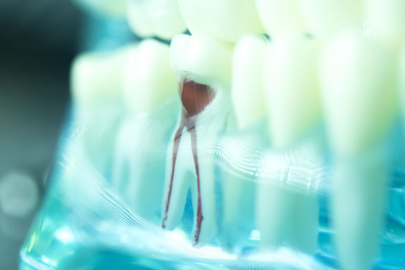 What’s Involved in Root Canal Therapy?
