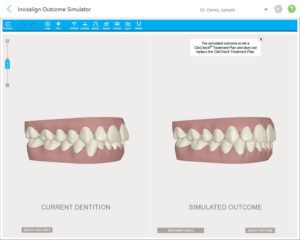 Example of Invisalign before and after comparison