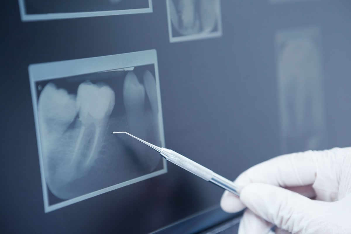 Hairline Tooth Fractures (cracks)