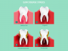 Stages of Gum Disease