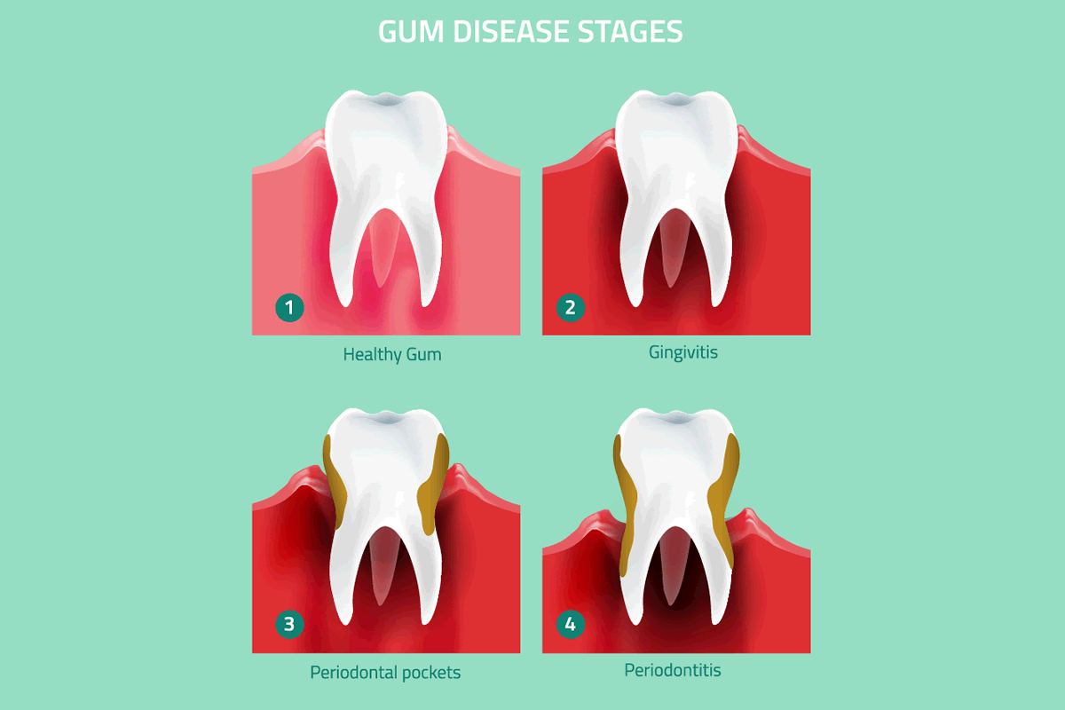 Stages of Gum Disease