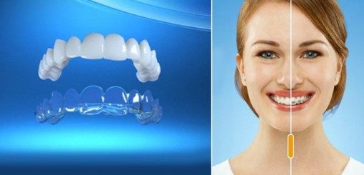 An image featuring a clear dental aligner on one side and a smiling woman on the other, showcasing the aligner's effect on her teeth. The background is a gradient blue, enhancing the focus on the aligner and the woman's smile.