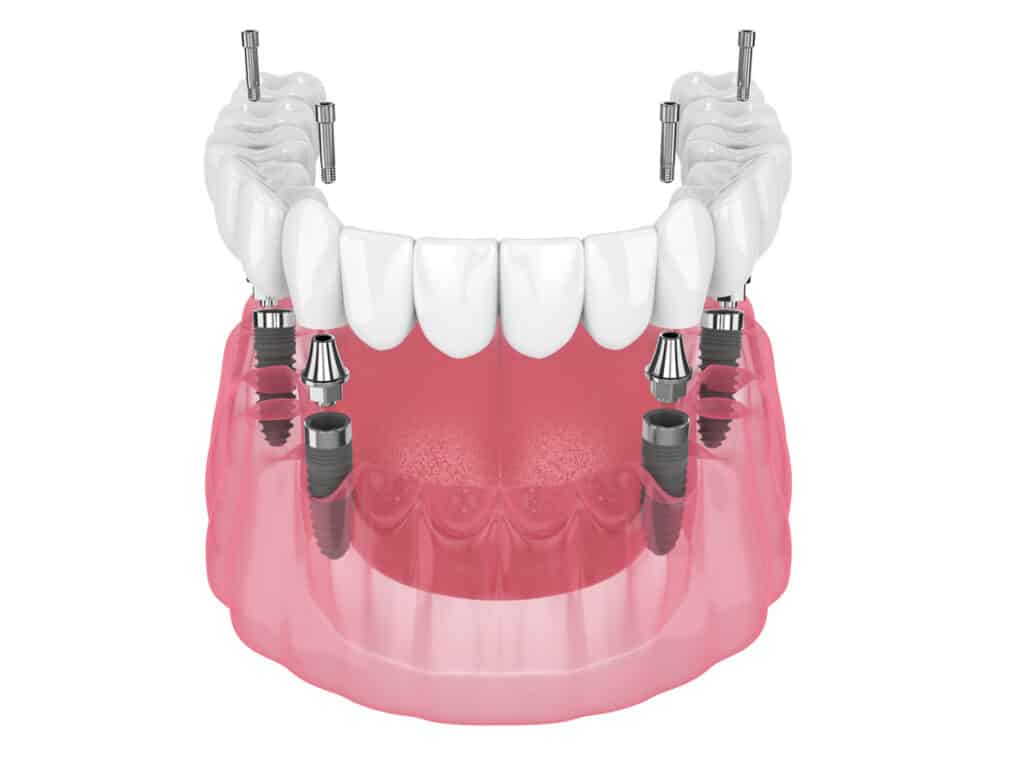 A dental implant model displaying a set of upper teeth with connected metallic fixtures, illustrating the placement of dental implants in a pink gum base. The image highlights the structure of a dental restoration system.