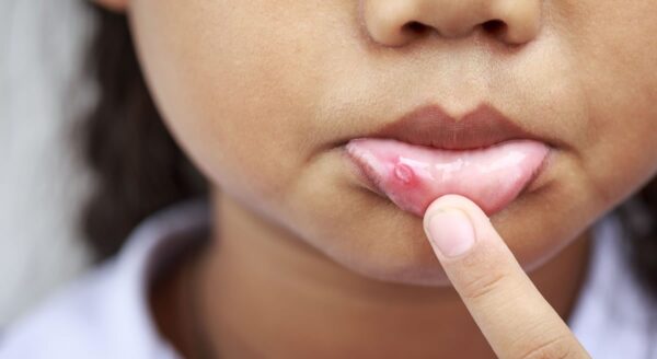 Canker Sores are a common condition characterized by the repeated formation of benign and non-contagious mouth ulcers (aphthae).