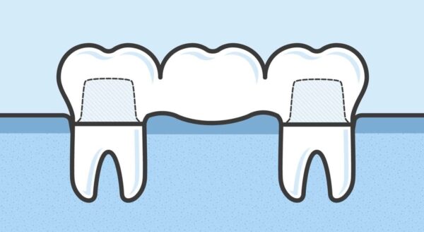 What are Dental Bridges and How Do They Work?