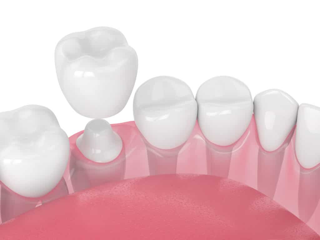 A dental model shows a row of teeth with a dental crown positioned above one of them, highlighting the process of dental restorations. The gum area is depicted in pink, emphasizing oral health care.
