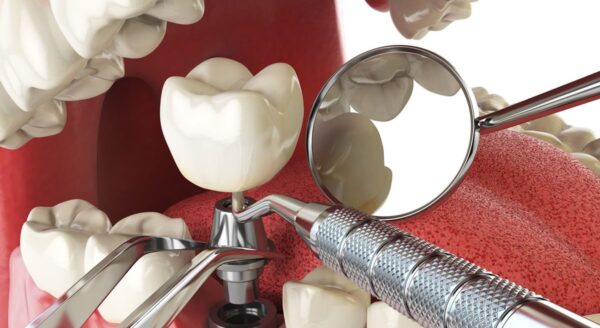 Dental Implant Key Elements