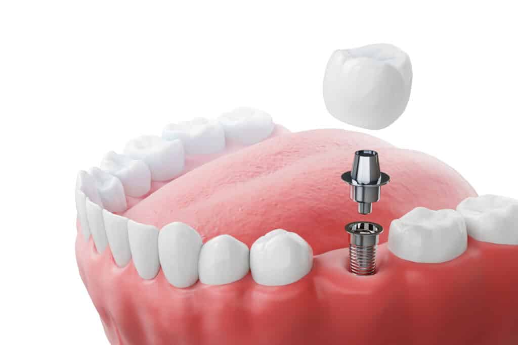 An illustration of a dental implant procedure, featuring a pink gum model with a silver implant and a white dental crown positioned above it. The image highlights dental restoration techniques for missing teeth.