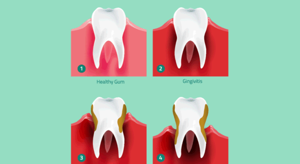 Stages of Gum Disease