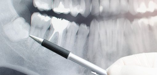 An dental X-ray image showing a close-up of teeth, with a hand holding a dental tool pointing at a specific area. The image highlights the structure of the teeth and potential dental issues.