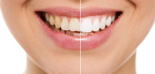 A split image showing a close-up of a woman’s smile, highlighting the difference between discolored and bright white teeth.