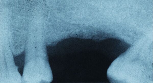 See a Prosthodontist for a missing tooth