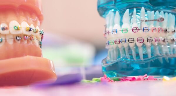 Does your child need orthodontic braces?