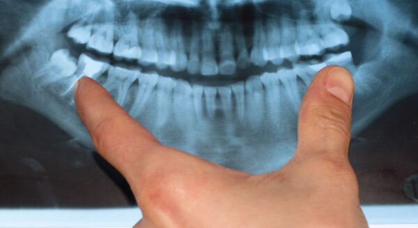 Panoramic Dental X-ray