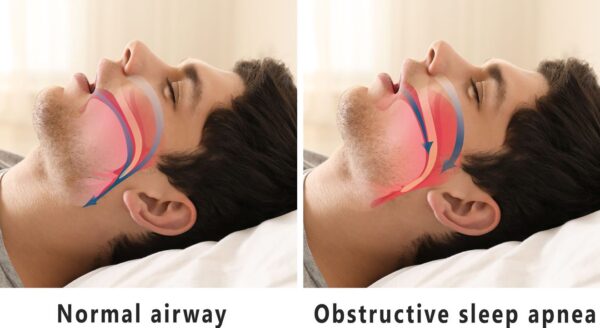 Sleep Apnea - How Your Dentist Can Help