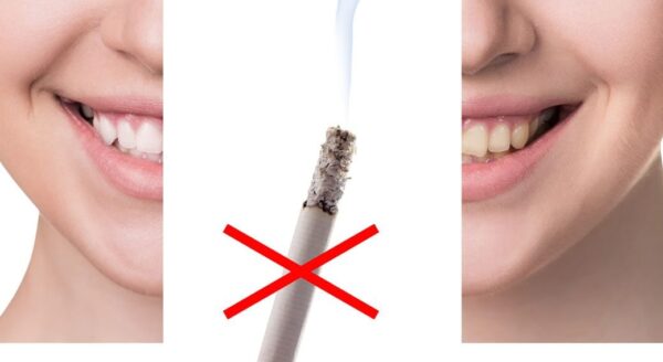 Why you should quit smoking.