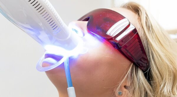 Home Whitening vs In-Office Whitening