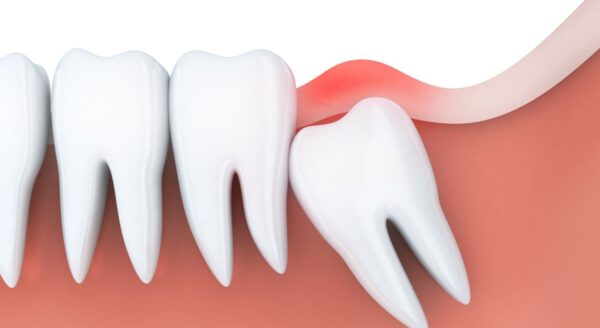 Wisdom Tooth Removal Process