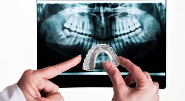 Do you need a mouthguard?