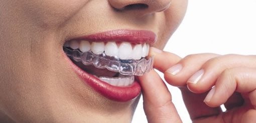 Gros plan d'une personne appliquant une gouttière orthodontique transparente sur ses dents, mettant en valeur son sourire éclatant avec des dents bien alignées et une main positionnant délicatement la gouttière. L'image représente les soins dentaires et les traitements d'orthodontie.